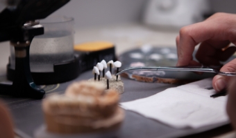 Что выбрать: виниры или коронки?