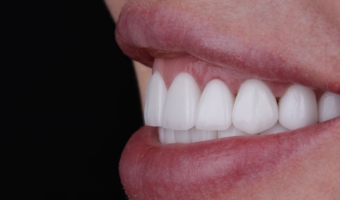 Реставрация улыбки винирами: кому подходит, плюсы и минусы