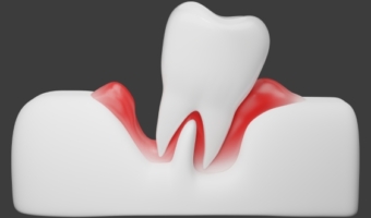 Все об удалении пародонтозных зубов
