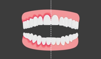 Все про запалення ясен: симптоми, причини та методи лікування