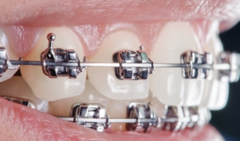 Все о самолигирующих брекетах: виды, показания, преимущества и недостатки