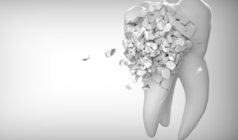 Коронка на зуб без нерва: зачем и когда ставить