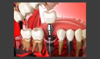 Базальная имплантация зубов: за и против