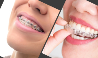 Цены брекетов на элайнеров в 2024 году