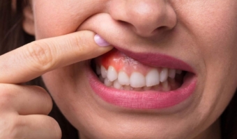 Чому запалення ясен – більше, ніж просто дискомфорт?