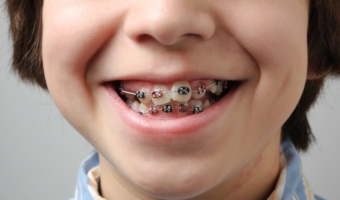 С какого возраста начинать ортодонтическое лечение зубов ребенку?