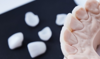 Сравнение виниров, коронок, протезов и накладок для восстановления зубов