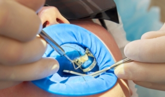 Коффердам в стоматологии: важный инструмент или лишняя роскошь?