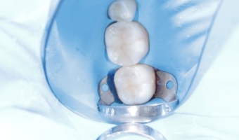 Пломба или композитная реставрация: что выбрать для восстановления зубов?