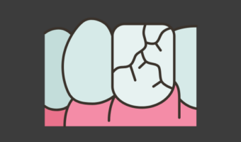 Реставрация зубов после травм: как вернуть улыбке красоту?