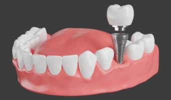 Сколько времени занимает имплантация зубов: обзор разных случаев