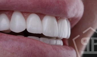 Цена на виниры в 2025 году – сколько стоит новая улыбка?