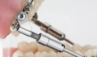 Аппарат Herbst – лечение дистального прикуса без хирургии