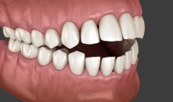 Лечение открытого прикуса: как исправить проблему без осложнений