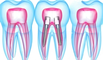 Восстановление зуба штифтом: показания и преимущества