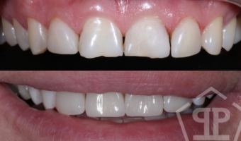 Актуальные цены на реставрацию зубов в 2026 году