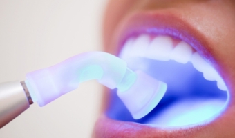 Рекомендации после установки фотополимерной пломбы