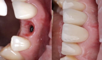 Лучшие зубные импланты: обзор и фото