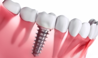 Имплант или сложное лечение поврежденного зуба?