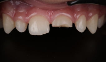 Відкол зуба у дитини: первинна допомога та лікування