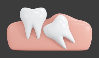 Зубы мудрости: удалять или оставлять?