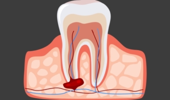Удаление кисты на корне зуба