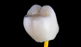 Протезирование – современные методы восстановления зубов