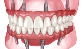 Революція в стоматології: чи здатні імпланти повністю замінити зуби?