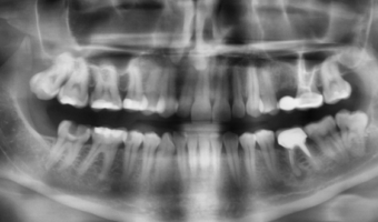 Рентген зубов перед лечением кариеса: важность точной диагностики