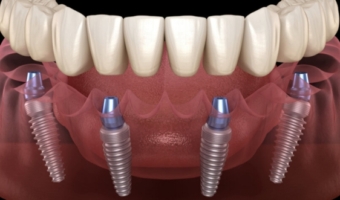 Революция в стоматологии: способны ли импланты полностью заменить зубы?