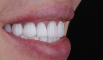 Вініри чи відбілювання зубів: як зробити правильний вибір?