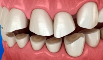 Бруксизм: причины, симптомы, лечение скрежета зубами