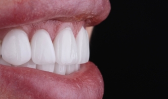 ТОП 10 мифов про керамические виниры