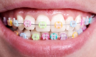 Металлические или керамические брекеты: какие выбрать для подростка?