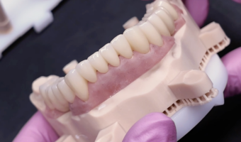 Коронки на имплантах или бюгельный протез: что выбрать?