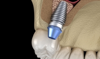 Рекомендации после синус-лифтинга от имплантолога