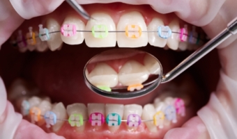 Исправление асимметрии лица выравниванием зубов