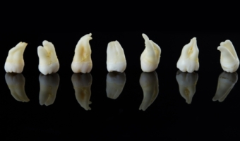 Удаление премоляров в ортодонтии