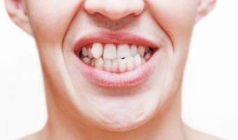 Перекрестный прикус – признаки и лечение