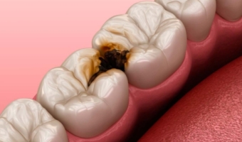 Контактний карієс: чому виникає та як запобігти?