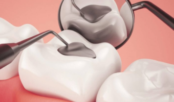 Временные пломбы – назначение и уход