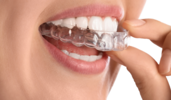 Ціни на елайнери у 2026 році – скільки коштує вирівняти зуби?