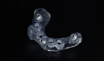 Хирургический шаблон для имплантации – применение и плюсы