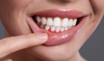 Чистка зубів при хворих яснах – як не нашкодити?