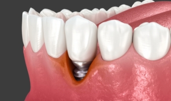 Оголение импланта: причины и лечение