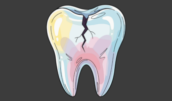 Выпала или сломалась коронка – что делать?