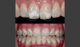 Білі плями на зубах: карієс чи естетичний недолік?