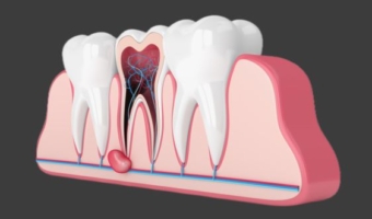 Цистектомія – видалення кісти зуба без рецидивів