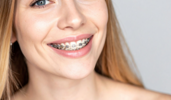 Професійна гігієна з брекетами