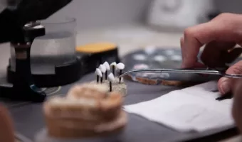 Что выбрать: виниры или коронки?